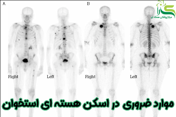موارد ضروری در اسکن هسته ای استخوان
