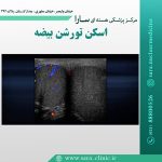 اسکن تورشن بیضه