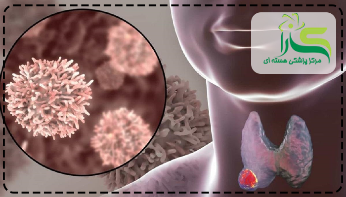 ید رادیو اکتیو چه عوارضی را در پی خواهد داشت؟