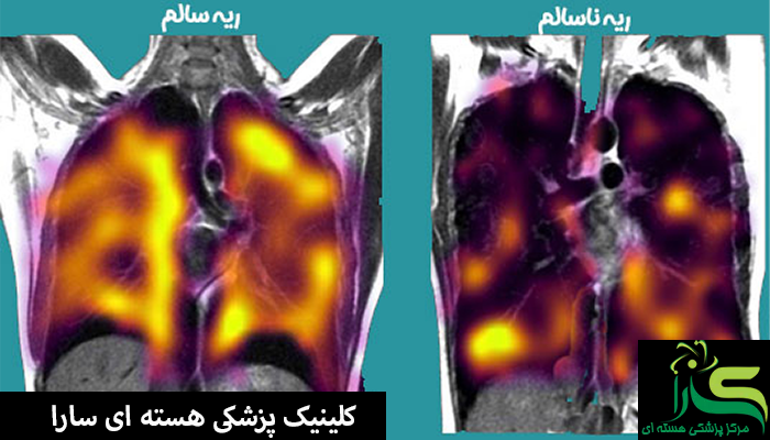 کاندیدای انجام اسکن ریه