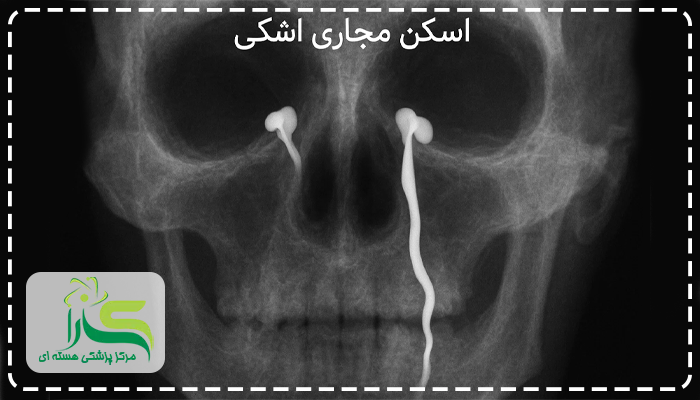 اسکن مجاری اشکی
