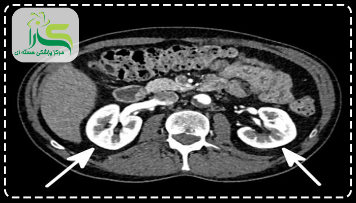 اسکن هسته ای کلیه