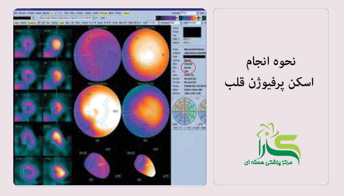 نحوه انجام اسکن پرفیوژن قلب