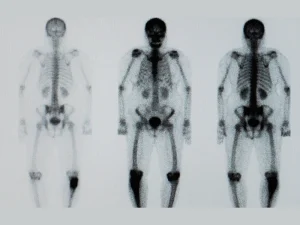 آیا اسکن هسته ای استخوان خطرناک است؟