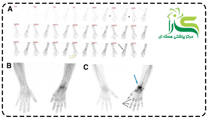 خطرات اسکن استخوان