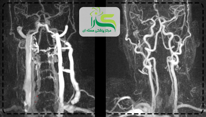 اسکن قلب یا آنژیوگرافی