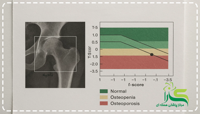 درمان تراکم استخوان چیست