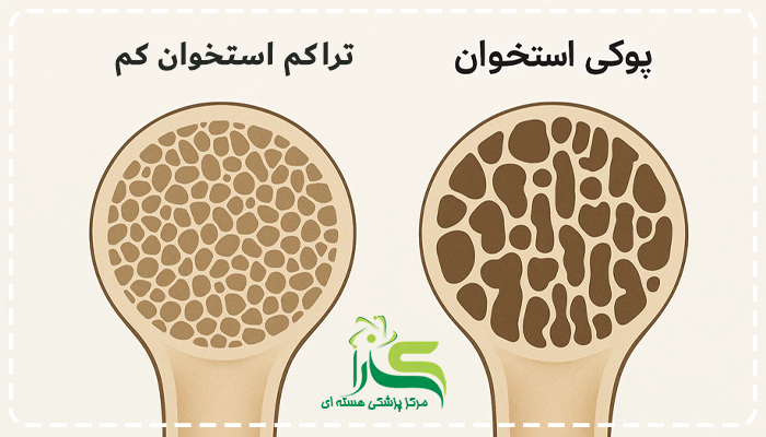 علائم تراکم استخوان چیست