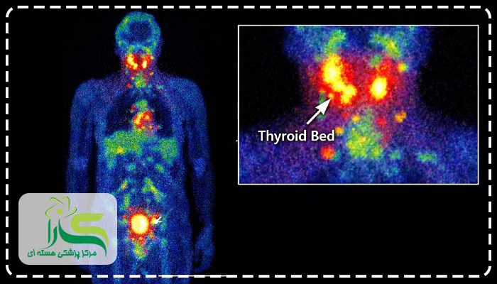 اسکن تمام بدن بعد از ید درمانی