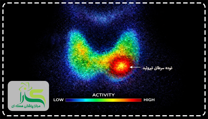 مدت زمان اسکن بعد از ید درمانی